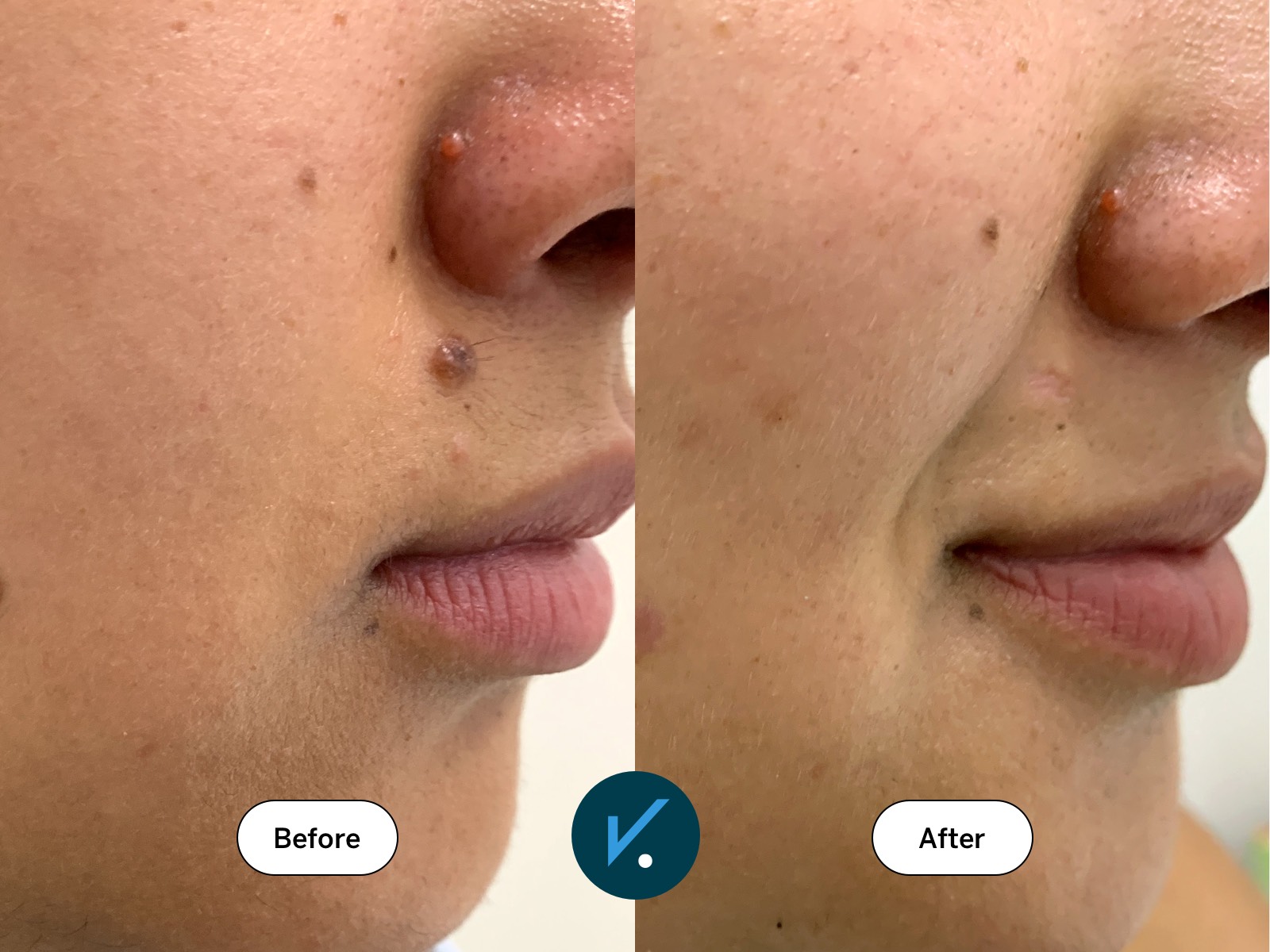 Radiofrequency mole removal - before and after