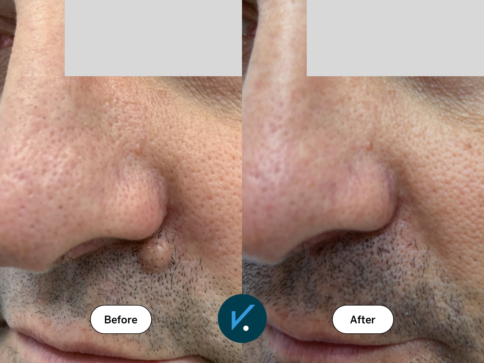 Radiofrequency mole removal - before and after