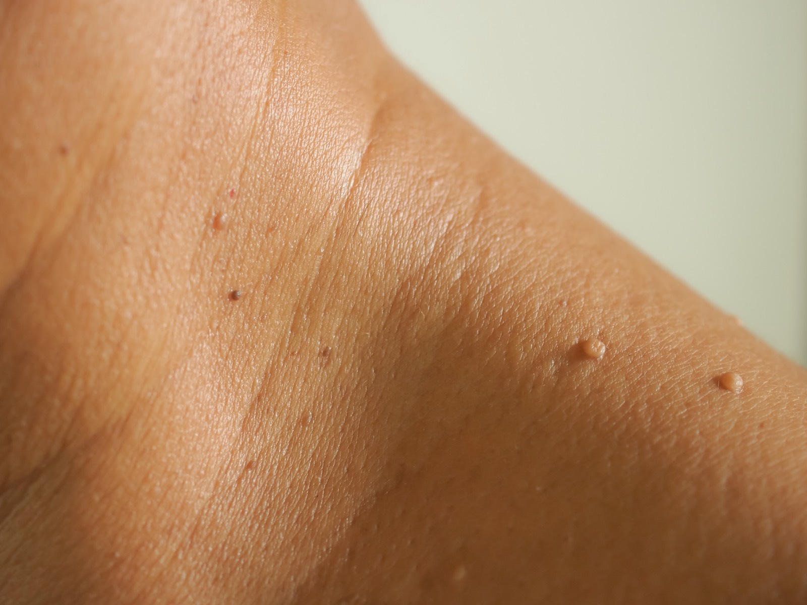 Skin tags on the neck and shoulder