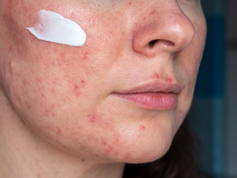 Woman using topical retiniod