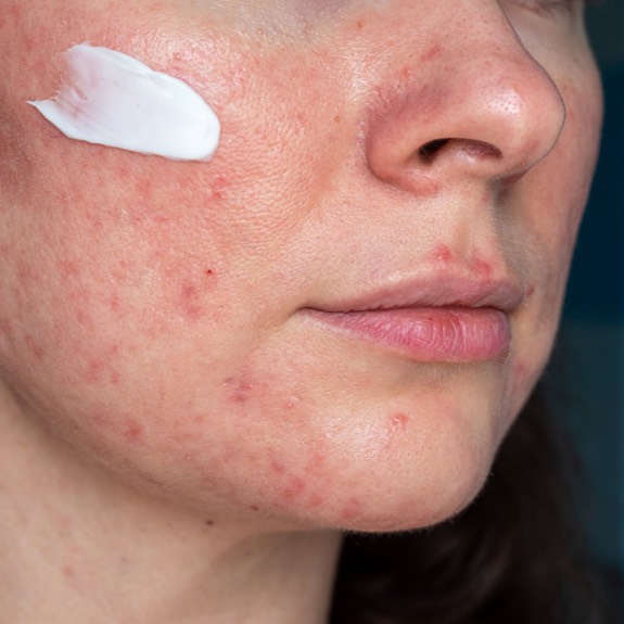 Woman using topical retiniod