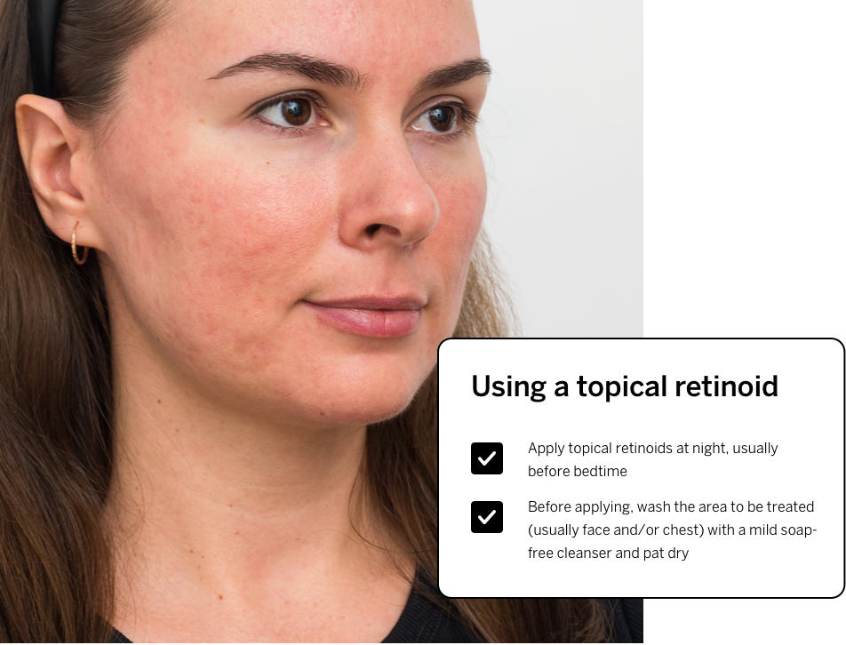 Using a topical retinoid - how to prepare