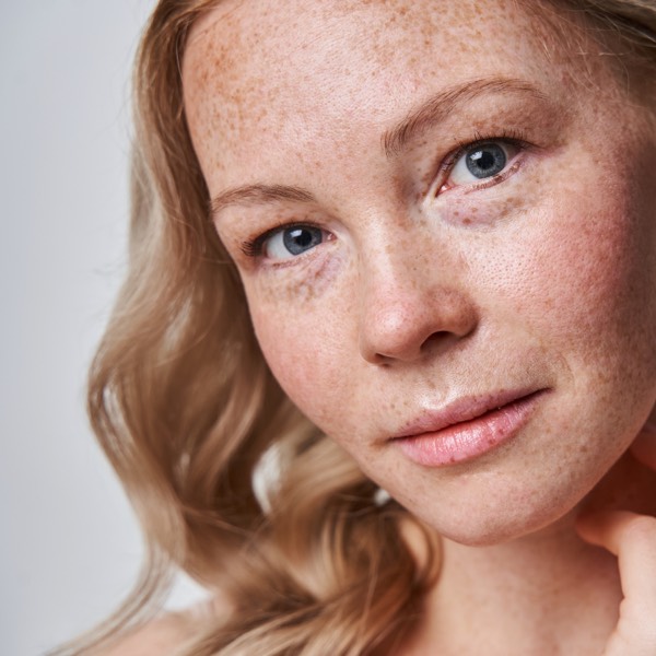 Young woman with sun damaged skin