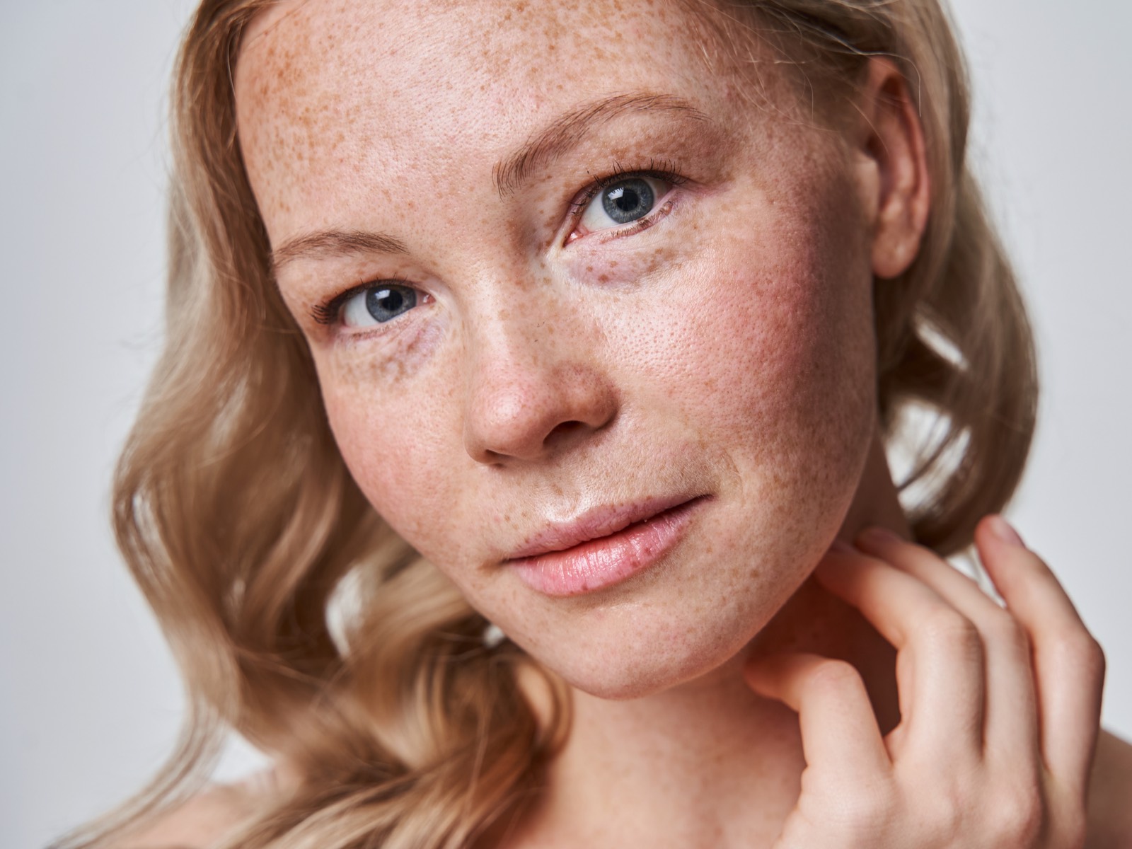 Young woman with sun damaged skin