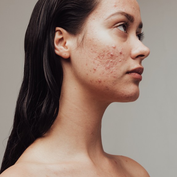 Woman with acne on face