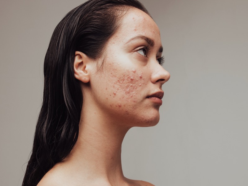 Woman with acne on face