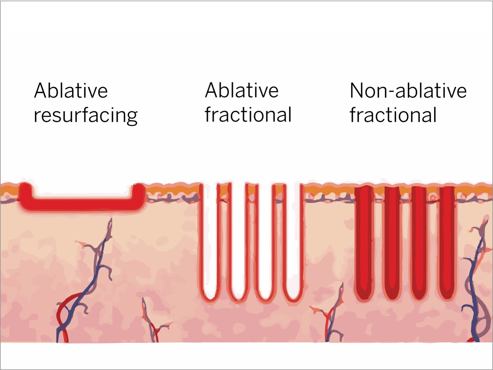 Fractional ablative vs non-ablative