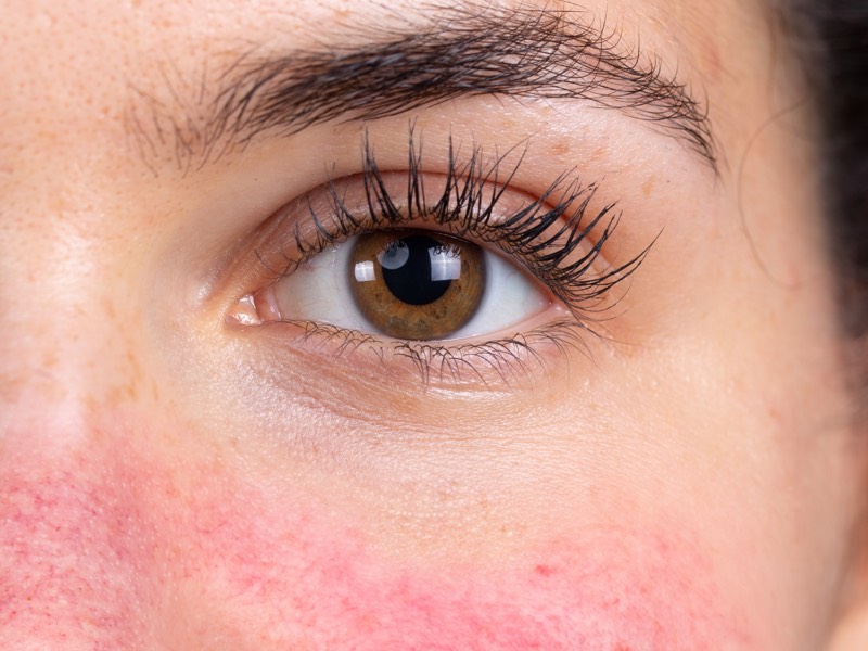 Rosacea of the cheeks and nose