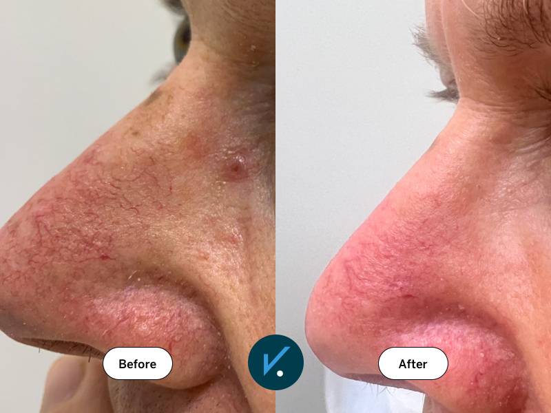 Before and after photodynamic therapy for basal cell carcinoma of the nose