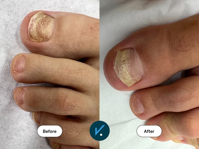 Laser fungal nail treatment before and after