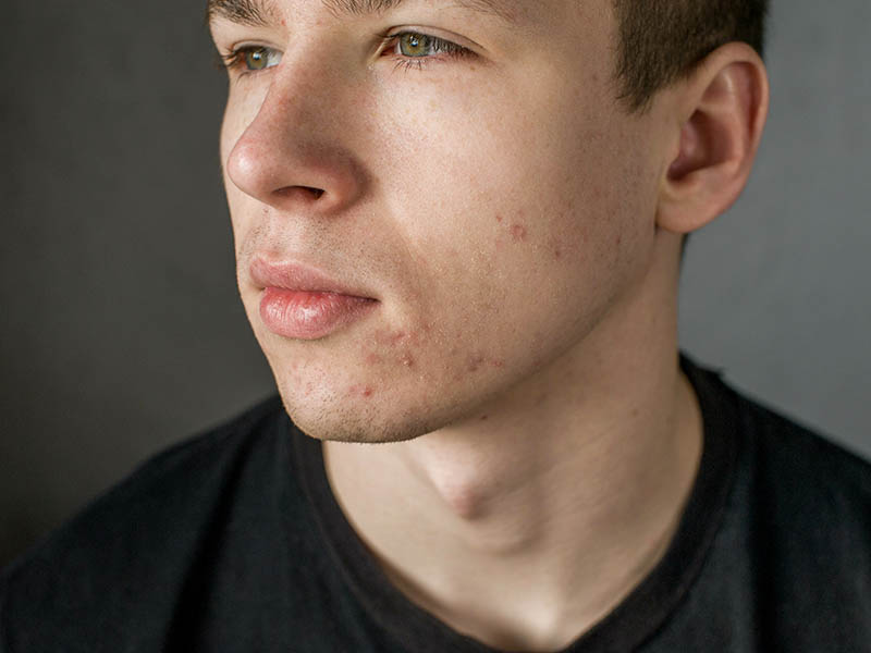 Young man with acne