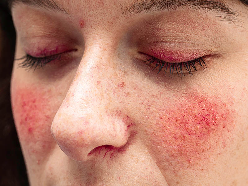 Rosacea causing rewdness, telangiectasia (visible capillaries), small pustules and inflammation around the eyes.