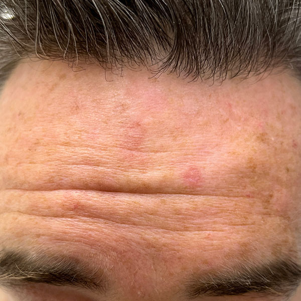 Solar keratoses on a man's forehead