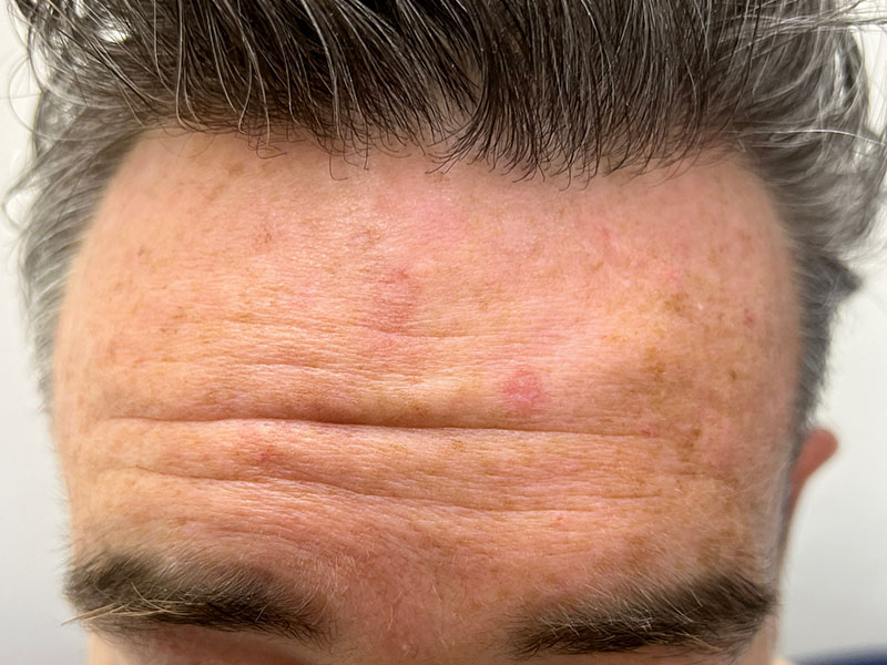 Solar keratoses on a man's forehead