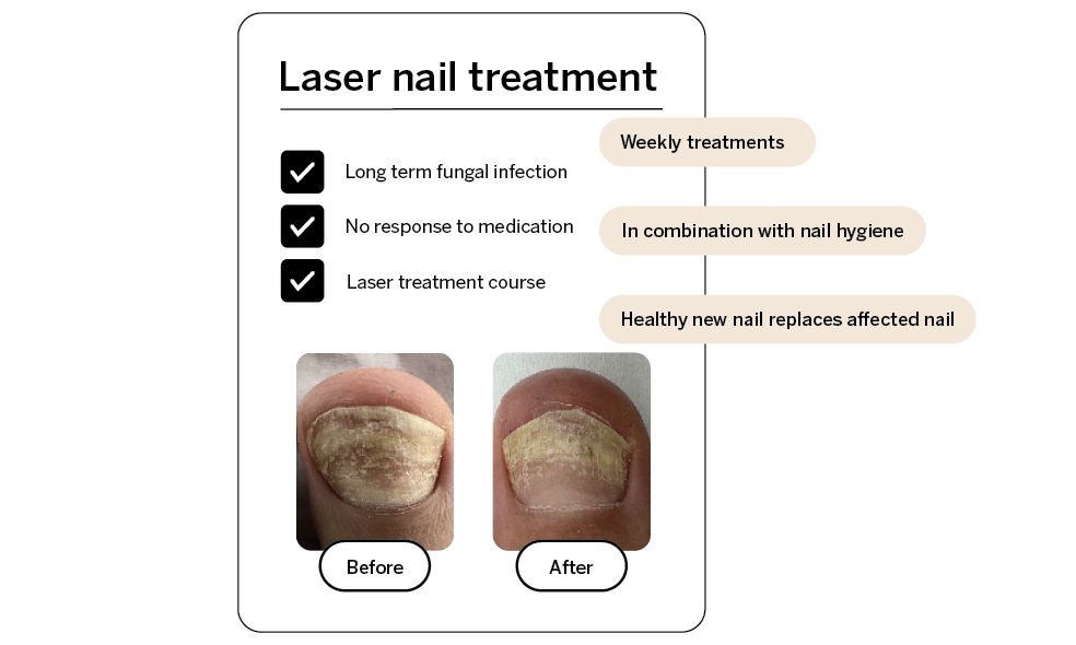 Laser nail treatment before and after