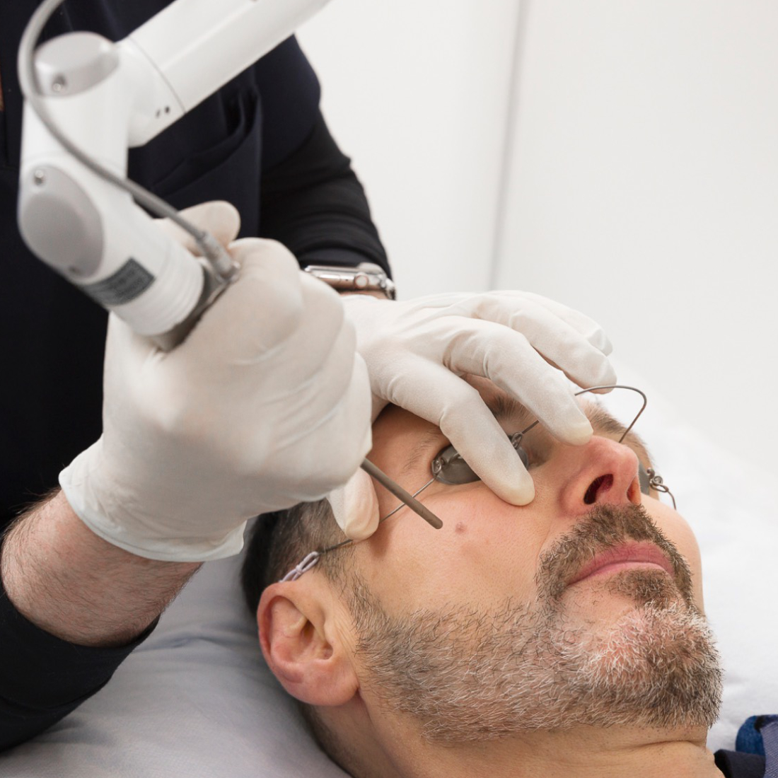 Clinician performing laser treatment on a patient's face, with protective eye shields in place