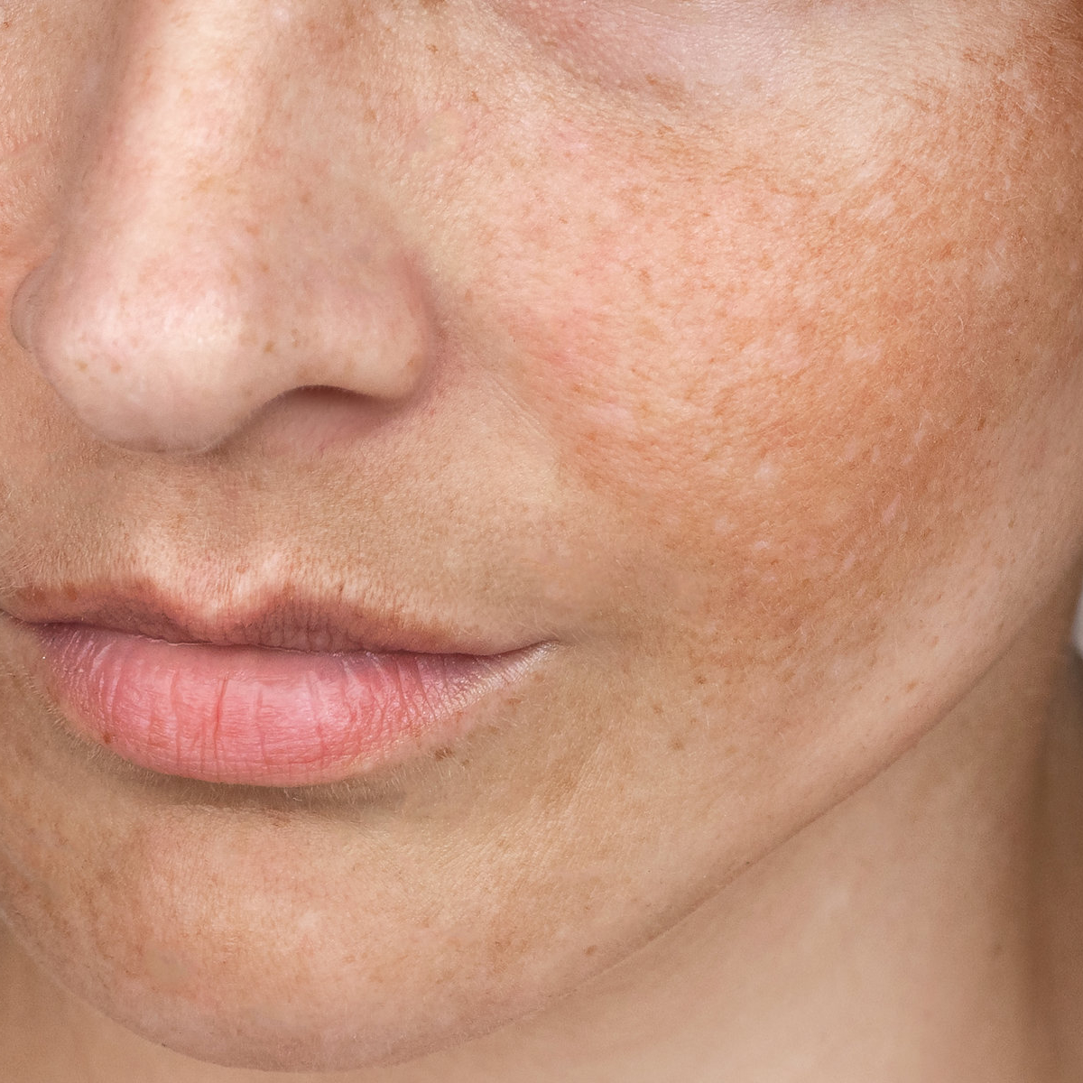 Melasma pigmentation across the cheeks and upper lip