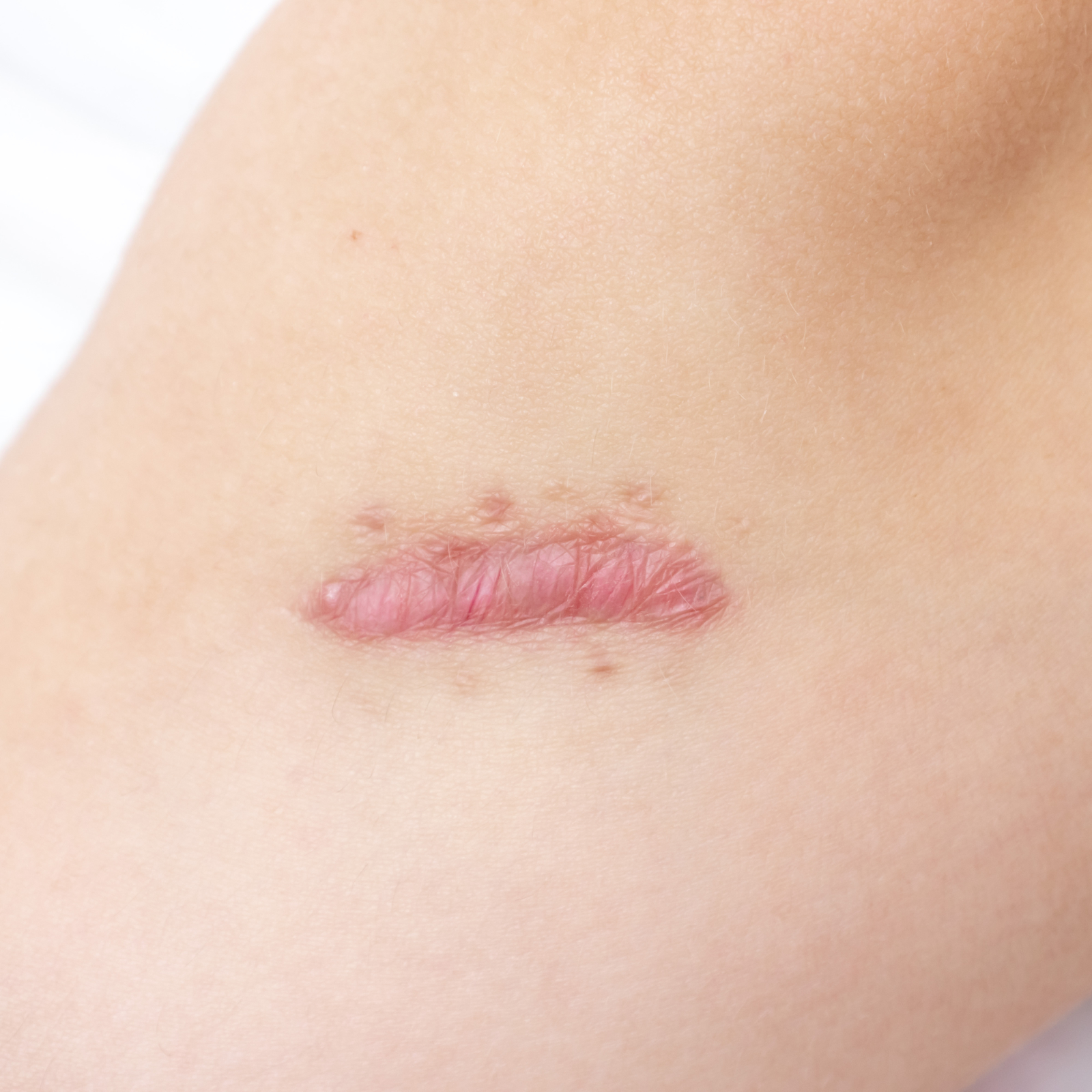 Close-up of a raised pink linear scar with surrounding skin visible.