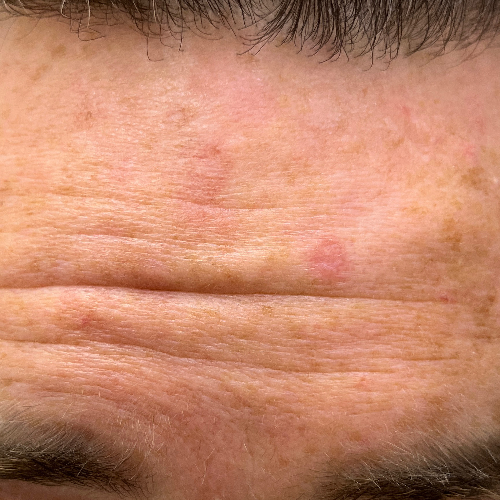 Close-up of pink, scaly patches and sun damage across a forehead.
