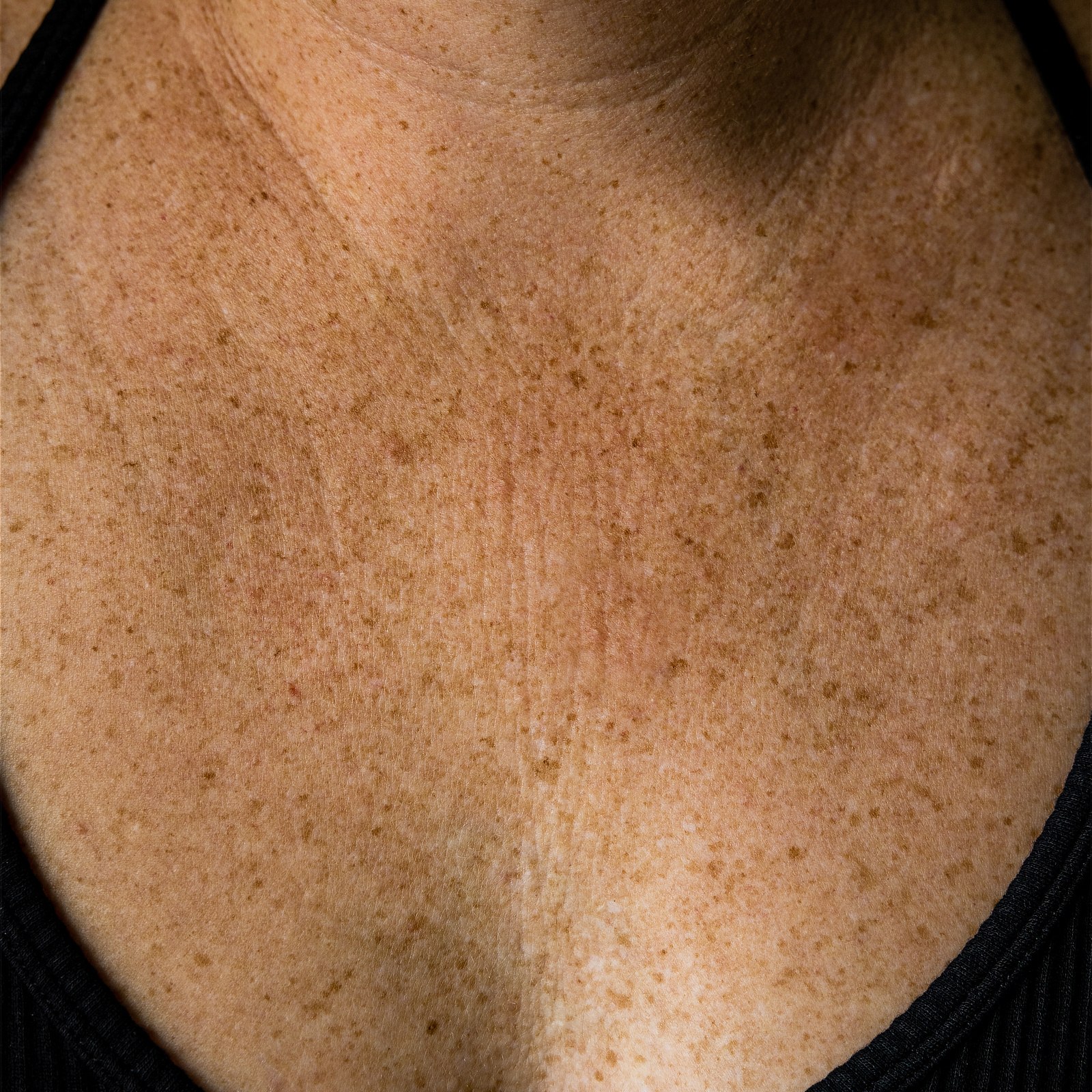 Sun spots, uneven pigmentation and fine lines on a woman’s upper chest.
